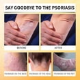 thumbnail image 3 of Bee Venom Psoriasis Care Spray, Psoriasis Spray Cooling Anti-Itch Skin Care Anti-Dandruff Light Redness Spray, 3 of 5