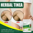 thumbnail image 3 of Crema de medicamentos para el tratamiento de infecciones pomada para alergias tiña del pie picazón en la piel a base de hierbas, 3 of 7