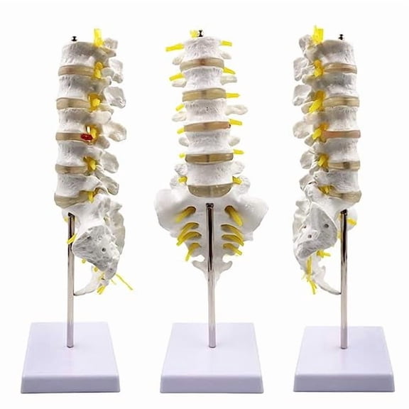 Wellden Product Medical Anatomical Model Lumbar Vertebrae w/ Sacrum & Coccyx, with Herniation Disc