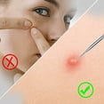 thumbnail image 4 of 4PCS Blackhead Remover Pimple Comedone Extractor Tool Acne Kit - Treatment for Blemish, Whitehead Popping, Zit Removing for Risk Free Nose Face Skin - Rose gold, 4 of 7