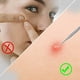 thumbnail image 4 of Apuakthei - Kit de 4 extractores de espinillas y comedones para eliminar el acné, tratamiento para eliminar imperfecciones, puntos blancos y granos para una piel libre de riesgos en la nariz y el, 4 of 7