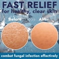 thumbnail image 6 of Antifungal Soap Infused with Peppermint Essential Oil | Medicated Tolnaftate 1% Soap for Itchy Skin, Athlete’s Foot, Ringworm & Jock Itch Treatment | Spearmint Freshness Bars Pack of 2 with Scrubber, 6 of 7