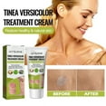 Tinea Versicolor Treatment Cream, Antifungal Cream for Tinea Versicolor