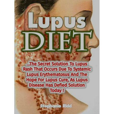 Lupus Diet: The Secret Solution To Lupus Rash That Occurs Due To Systemic Lupus Erythematosus And The Hope For Lupus Cure, As Lupus Disease Has Defied Solution Today! - (Best Cure For Heat Rash)