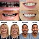 thumbnail image 3 of Artificial Teeth Dentures Temporary Quick Dental Prosthesis Top Perfect Smile), 3 of 3