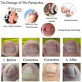 thumbnail image 4 of FS 12Pcs Ingrown Toenail Correction Pedicure Tool Elastic Patch Straightening Clip Caring, 4 of 5