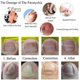 thumbnail image 4 of FS 12Pcs Ingrown Toenail Correction Pedicure Tool Elastic Patch Straightening Clip Caring, 4 of 5