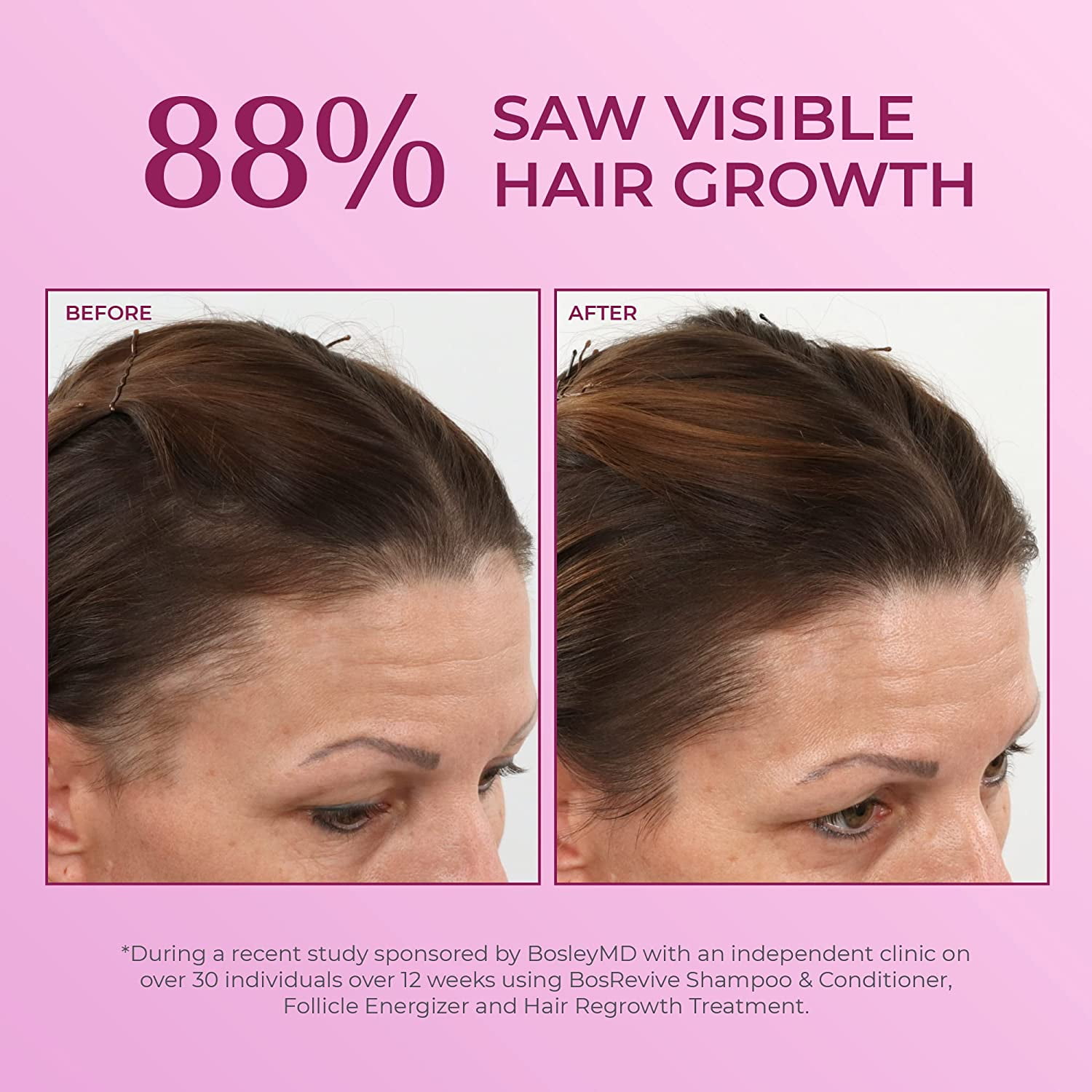 BosleyMD Women's Regrowth Treatment 2% Minoxidil Spray