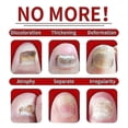 thumbnail image 2 of 2x 30ml Nails Care Repair Nail Fungal Anti-fungus Onychomycosis-removal Liquid Ginger Foot Antifungal Nail Treatments - Hz, 2 of 5