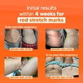 thumbnail image 4 of Cicatrissim Deep Stretch Mark Removal Cream - Innovative Formula With Pure and Powerful Natural Ingredients From Brazilian Flora - For All Stretch Marks & Skin Types., 4 of 7