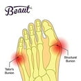 thumbnail image 5 of Beaut Bunion Corrector Toe Straightener Relief with Euronatural Gel, Metatarsal Pad for Hammertoe and Hallux Valgus, 5 of 6