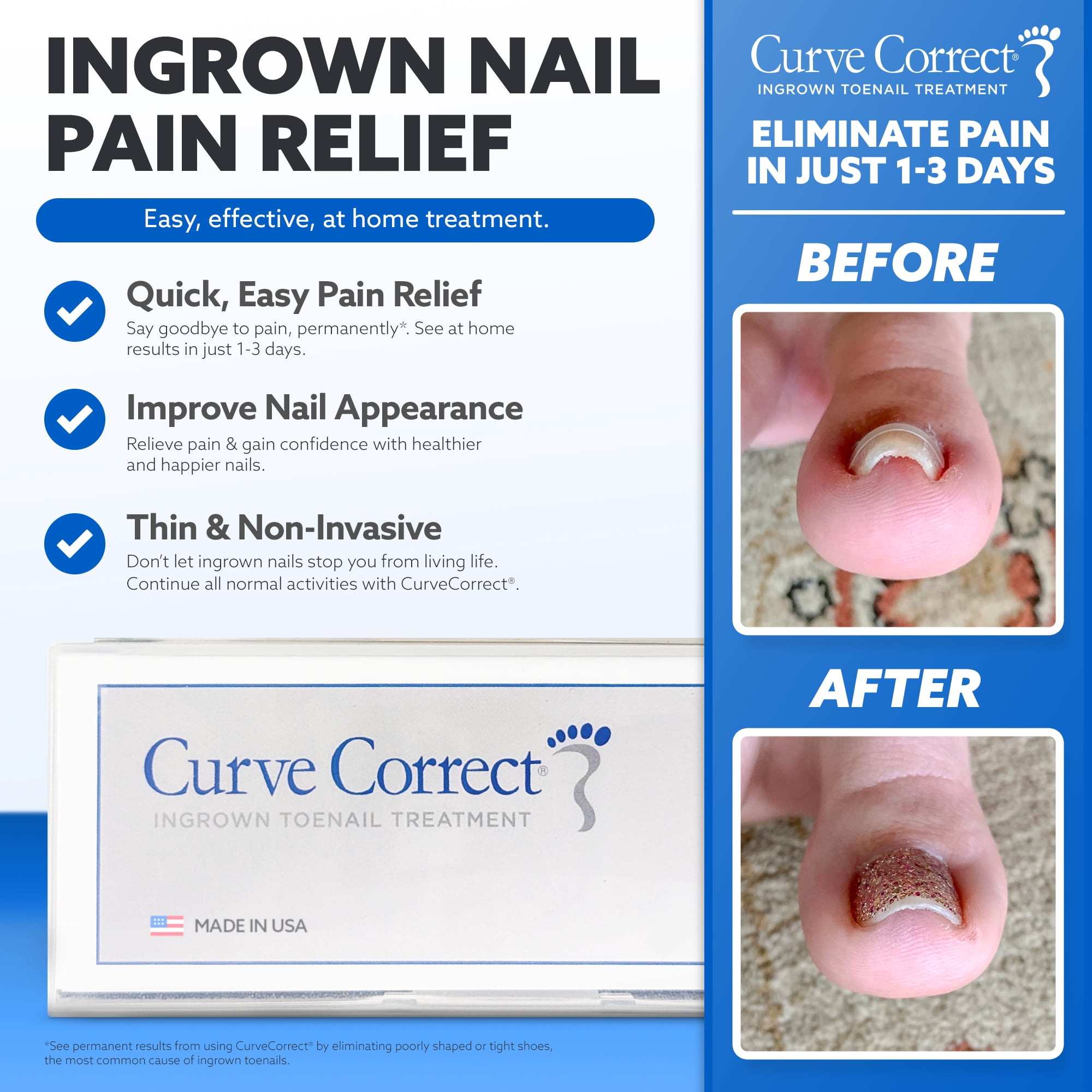 CurveCorrect® Ingrown Toenail Corrector Kit - 10 Braces for In Grown Toe Nail Treatment