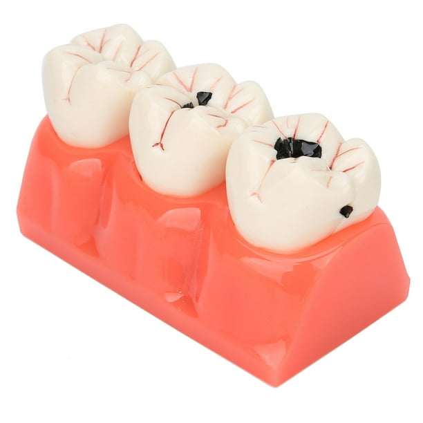 Simulation Teeth Caries Model,Dental Caries Model Tooth Dental Caries ...