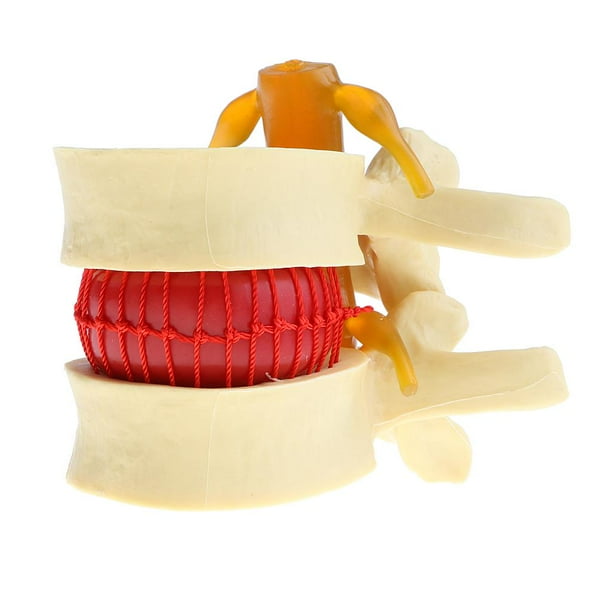 Nuevo o De Protrusión D Intervertebral De Zulema Estatua de protrusión del disco lumbar