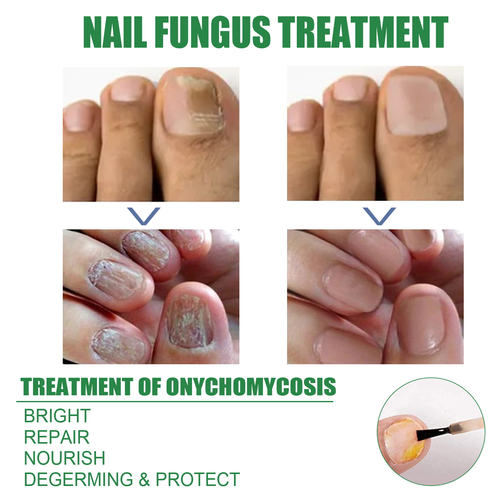 How to Treat Toenail Fungus with Essential Oils - The Miracle of Essential  Oils