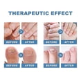 thumbnail image 5 of 1-3 cajas de parches para el tratamiento de uñas, antihongos, corrección de uñas, paroniquia, uñas encarnadas, parches de cuidado, antiinfecciones, 1 caja, 5 of 5