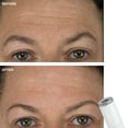thumbnail image 4 of Trophy Skin Microdermabrasion Standard Diamond Tip Accessory for MicrodermMD MiniMD and RejuvadermMD Exfoliation Beauty Device Systems, 4 of 6