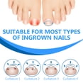 thumbnail image 6 of Ingrown Toenail Treatment, Titanium Alloy Ingrown Toenail Corrector, Ingrown Toenail Removal Kit for All Size Toenail, Curved Nail Repair Tools, 6 of 9