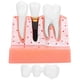 thumbnail image 1 of Modelo de dientes Análisis de implantes dentales Modelo de puente de corona Modelo de diente de demostración, 1 of 14