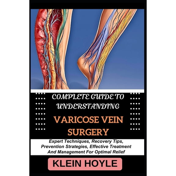 Complete Guide to Understanding Varicose Vein Surgery: Expert Techniques, Recovery Tips, Prevention Strategies, Effectiv, (Paperback)