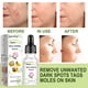 thumbnail image 3 of Mole Removal Serum 3Pcs Herb Plant Extracts Mole Corrector Skin Tag Remover Remove Moles with No Scars, 3 of 5