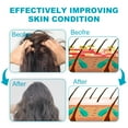 thumbnail image 5 of Dandruff Shampoo - Itchy & Dry Scalp Treatment, Psoriasis Shampoo for Women & Men, Scalp Anti Dandruff Relief - Daily Hair Shampoo, 5 of 7