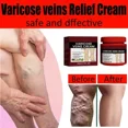 thumbnail image 2 of Pomada para venas varicosas, crema efectiva para aliviar la Vasculitis, flebitis, tratamiento del dolor de araña, cuidado de los pies, 2 of 5
