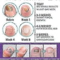 thumbnail image 5 of Medinail Fungus Spray,Toenail Fungus Treatment,Nail Fungus Treatment For Toenail, 5 of 5