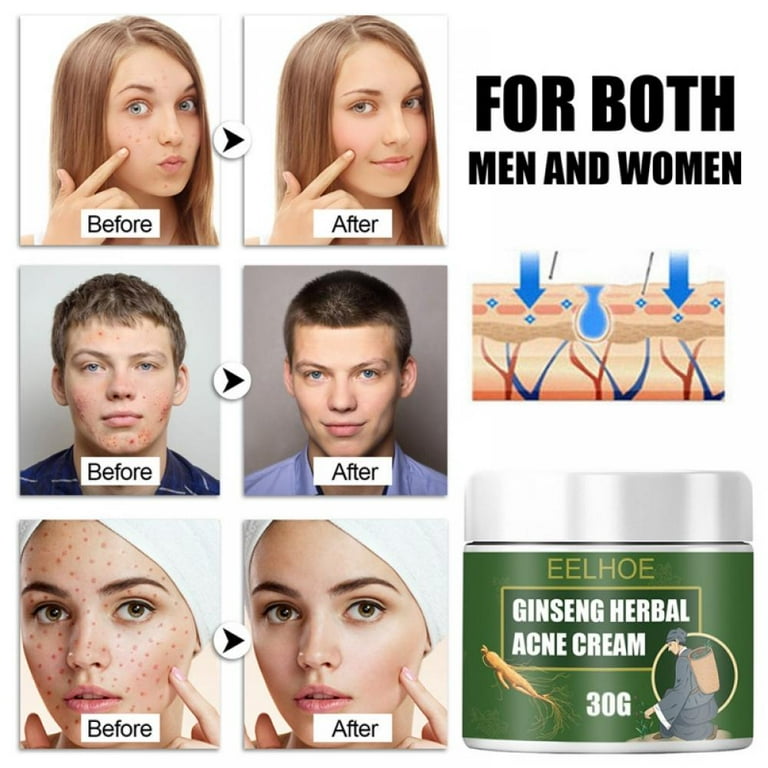 Ginseng Herb Anti Acne Treatment Cream Acne Removal Fighting