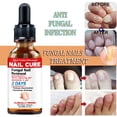 thumbnail image 2 of Nuevo Tratamiento De Hongos En Las Uñas De Los Pies Eliminación Anti Infección Onicomicosis Reparación De Cuidado, 2 of 3
