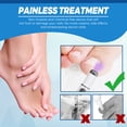 thumbnail image 3 of Para El Cuidado Las Uñas Reparadora Herramientas Indoloras Antihongos Onicomicosis, 3 of 9