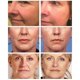 thumbnail image 4 of Suero de extracto de caracol, esencia facial, antiarrugas, ácido hialurónico, antienvejecimiento, colágeno, blanqueador, hidratante, cuidado facial, envío gratuito, 4 of 5