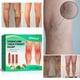 thumbnail image 5 of Jumpingount Eliminador de varices de extracción Natural, de viaje, circulación sanguínea, herramienta de eliminación de venas varicosas, Protección de la piel, 5 of 6
