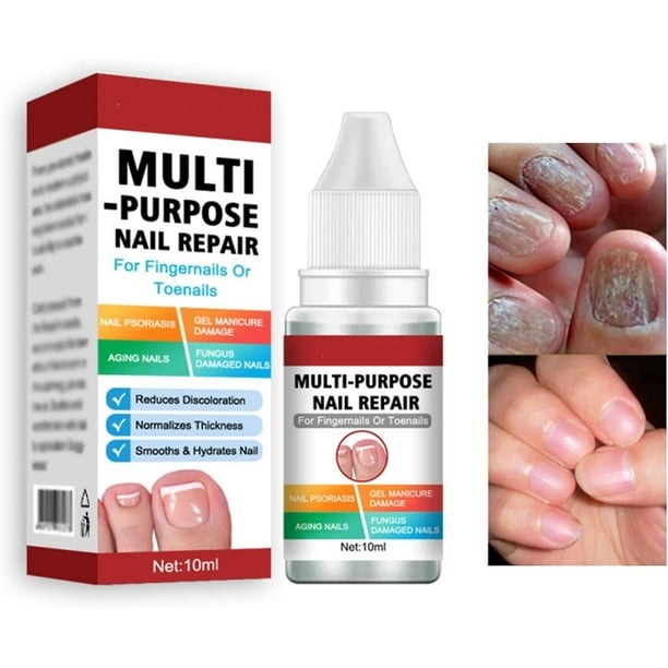 Fungal Nail Treatment For Toenail Extra Strong,multipurpose Nail