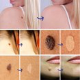 thumbnail image 4 of Bolígrafo Removedor De Etiquetas De Piel Eliminador de etiquetas de piel portátil Pen Patch Wart Remove Acne Mole Treatment Tool Ndcxsfigh Cuidado Belleza, 4 of 8