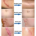 thumbnail image 4 of NewKeloid crema de eliminación rápida de cicatrices, tratamiento de estrías, quemaduras, hiperplasia quirúrgica, cicatrices, acné, reparación de manchas, blanquea la piel suave, 4 of 5