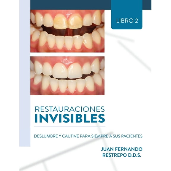 Restauraciones Invisibles: Deslumbre Y Cautive Para Siempre A Sus Pacientes, (Paperback)