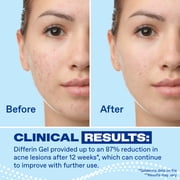 Differin Prescription-Strength Retinoid Acne Treatment Gel for Face with 0.1% Adapalene, Clears & Prevents Acne, Fragrance-Free, 15g Tube