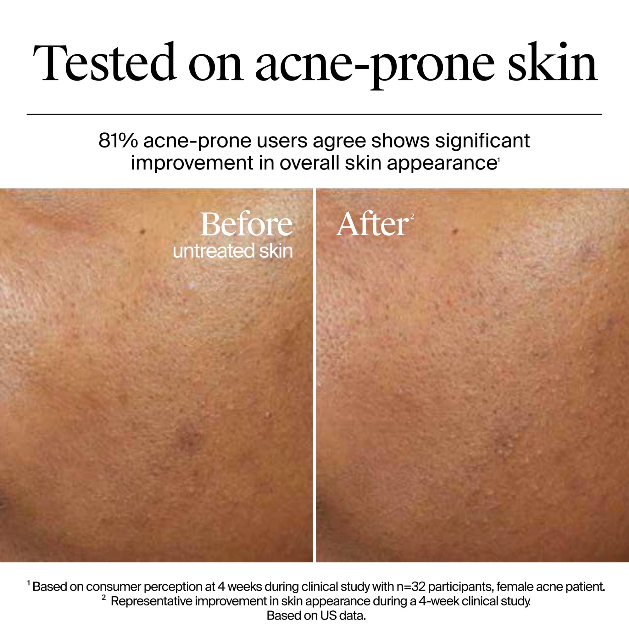 Neutrogena Hydro Boost Fragrance Free Face Moisturizer with Hyaluronic Acid for Dry Skin, Gel Cream Moisturizer For a Refreshing Burst of Hydration & Glowing Skin, Non-Comedogenic