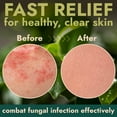 thumbnail image 3 of Body Spray with Tea Tree Oil | Fast-Absorbing Antifungal Treatment for Jock Itch, Athlete’s Foot, Ringworm & Nail Fungus | Soothes Itching, Burning & Scaling | Relieves Irritated Skin | 120ml, 3 of 7