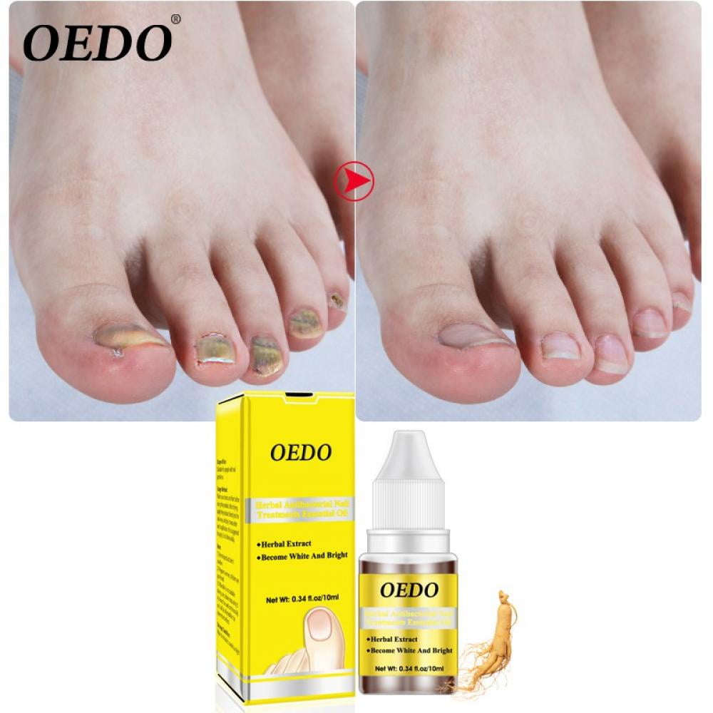 Pure Anti-fungal Nail Blend For Black Infected Nails, Promotes Healthy  Cuticles, Herbal Blend for Treatment for Nails 