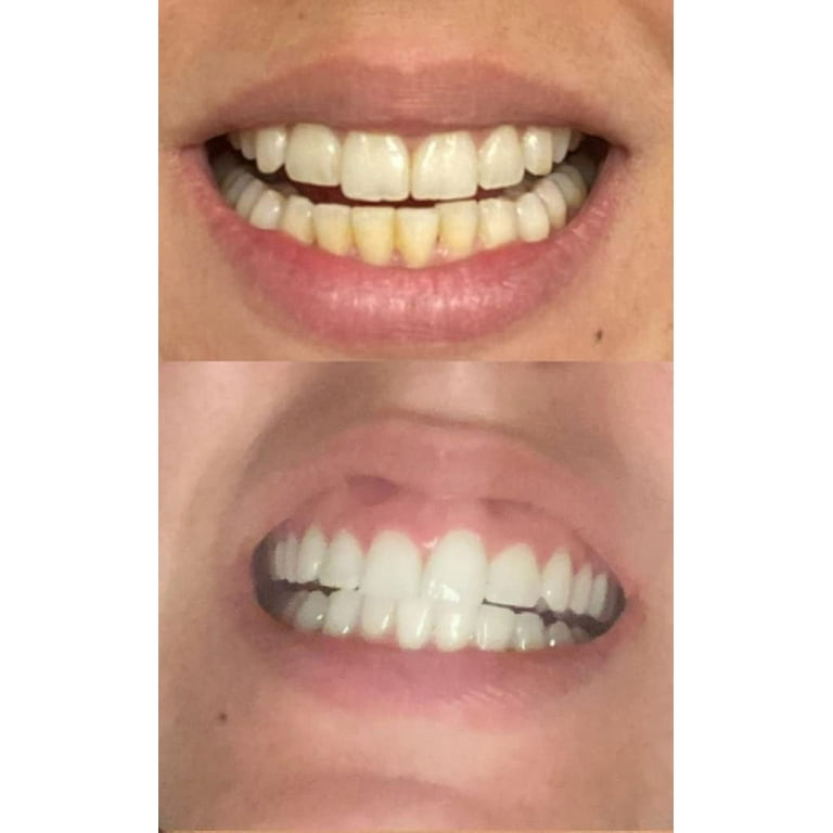 Smile Titan Teeth Whitening Gel Refill 4X Syringes 44