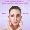 thumbnail image 4 of Dispositivo de fototerapia YourMate con varita facial de alta frecuencia, 4 of 6