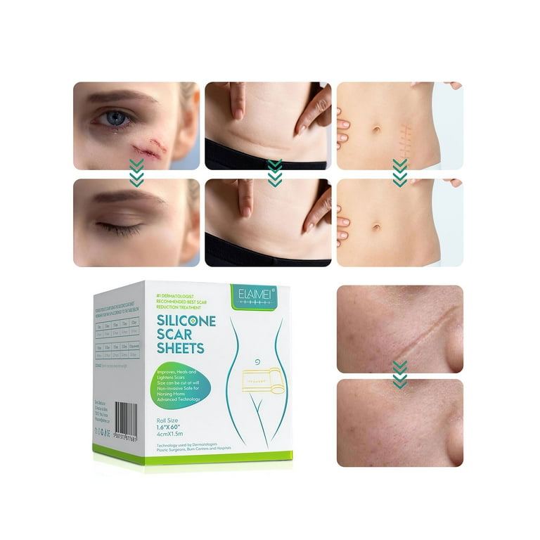 Scar reduction silicone sheets deals