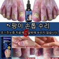 thumbnail image 2 of Tratamiento de uñas para el cuidado de los pies, esencia blanqueadora para los pies, Gel antiinfección para eliminación de hongos en las uñas de los pies, 2 of 5