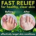thumbnail image 5 of Antifungal Foot Powder with Miconazole Nitrate 2% & Tea Tree Oil for Fungus Treatment | Soothes Itchy Skin, Controls Odor & Prevents Reinfection, 5 of 6