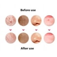 thumbnail image 4 of Professional Surgical Blackhead Remover Tools Blemish and Splinter Acne Pimple Removal Kit Come Done Extractor Tool for Whitehead Pimples and Zit Popper Leather Case Pack of 6, 4 of 4