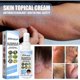 thumbnail image 5 of 2Pcs Ringworm Cream - Treats Stubborn Ringworm Infections, Fights Ringworm On Skin, Anti-Fungal Tolnaftate, Powerful Treatment,30ml, 5 of 5