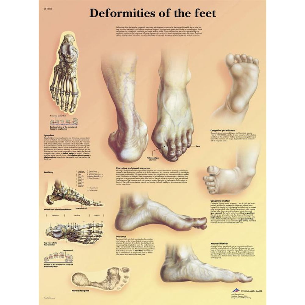 Anatomical chart: deformities of the feet, laminated - Walmart.com ...