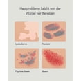 thumbnail image 5 of Portable 311nm UVB Phototherapy Lamp with Timer & Safety Goggles for Skin Treatment, 5 of 5